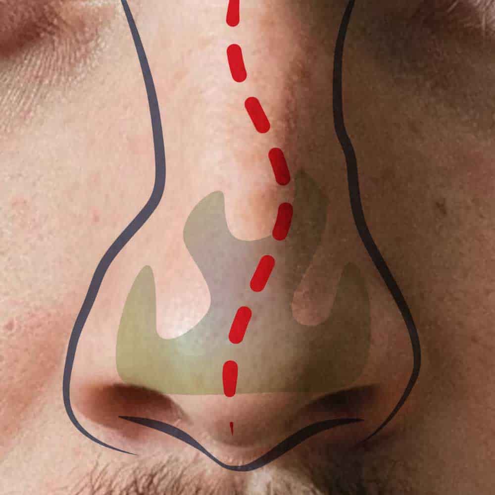 Septumplastik, Septumkorrektur, Nasenscheidewandkorrektur